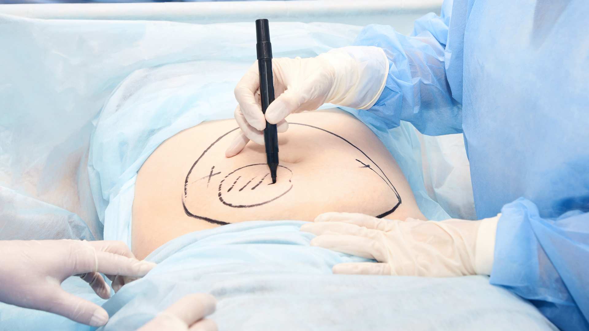 Comment choisir un chirurgien pour une liposuccion à Nice ?